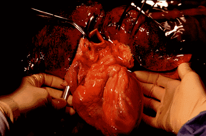 transplantation coeur