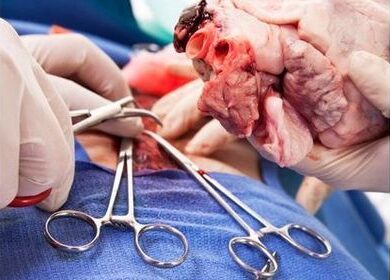 Nouveau : La première chirurgie de transplantation sur un cœur battant à l&rsquo;hôpital LLR