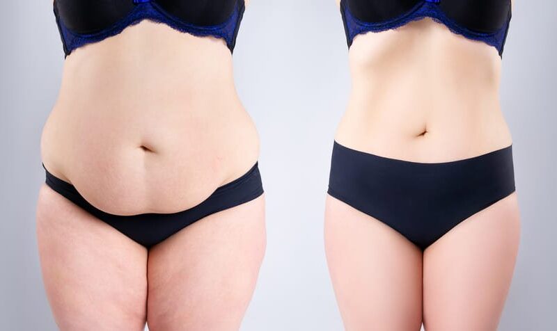 Quels sont les résultats d’une lipoaspiration du ventre en Tunisie ?