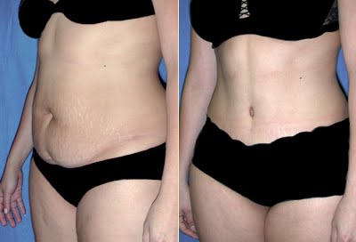 abdominoplastie avant apres