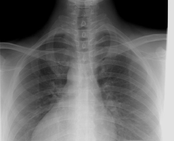 chirurgie thoracique Tunisie